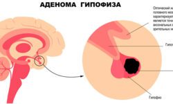 Аденома гипофиза