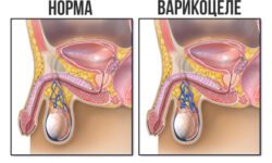 варикоцеле